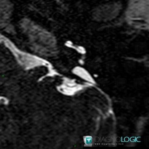 Enlarged vestibular aqueduct, Temporal bone, Inner ear, MRI