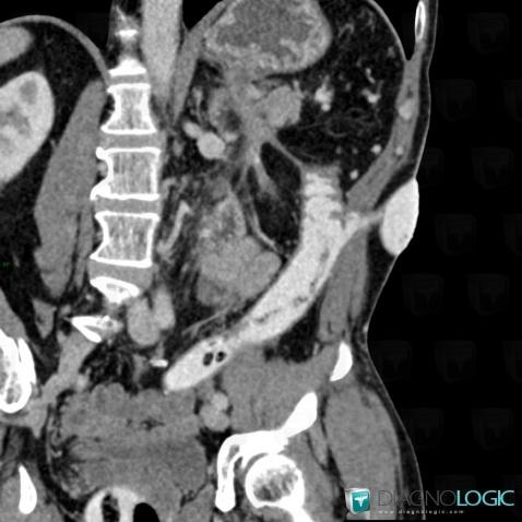 Radiology case : Enteric fistula / Other (CT) - Diagnologic