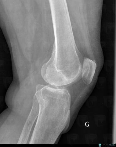 Enthésopathie-quadriceps, Tendon quadricipital, Radio