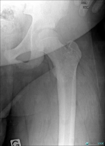 Enthésopathie - Tendinopathie / Bassin, Muscles - Bassin, Radio