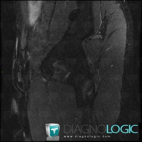 Enthesopathy - Tendinopathy / Pelvis, Ilium, Pelvic Muscles, MRI