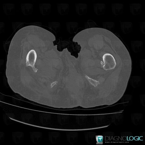 Enthesopathy - Tendinopathy / Pelvis, Pelvic Muscles, CT