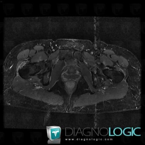 Enthesopathy - Tendinopathy / Pelvis, Pelvic Muscles, MRI