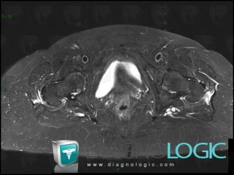 Enthesopathy - Tendinopathy / Pelvis, Pelvic Muscles, MRI