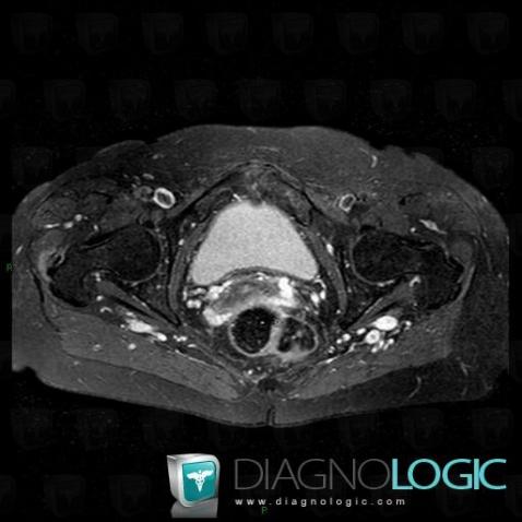 Enthesopathy - Tendinopathy / Pelvis, Pelvic Muscles, MRI