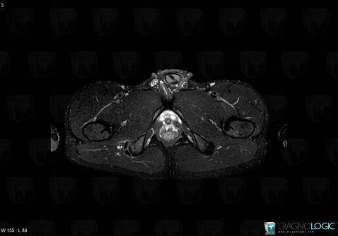 Enthesopathy - Tendinopathy / Pelvis, Pelvic Muscles, MRI