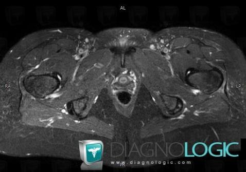 Enthesopathy - Tendinopathy / Pelvis, Pelvic Muscles, MRI