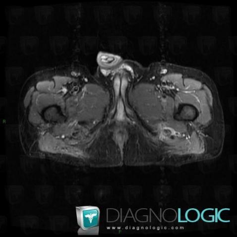 Enthesopathy - Tendinopathy / Pelvis, Pelvic Muscles, MRI