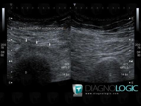 Enthesopathy - Tendinopathy / Pelvis, Pelvic Muscles, US