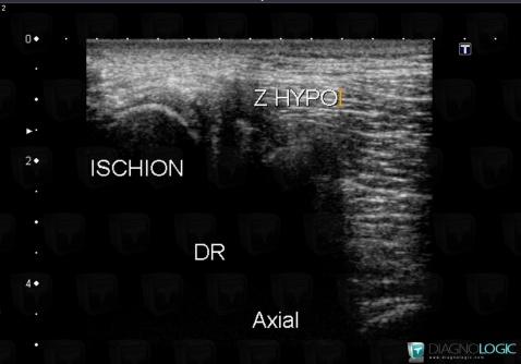 Enthesopathy - Tendinopathy / Pelvis, Pelvic Muscles, US