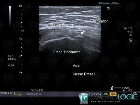 Enthesopathy - Tendinopathy / Pelvis, Pelvic Muscles, US