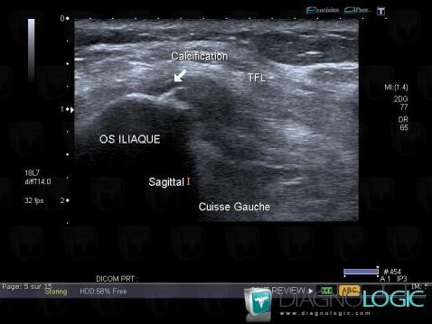 Enthesopathy - Tendinopathy / Pelvis, Pelvic Muscles, US