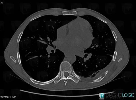 Eosinophilic granuloma, Ribs, CT