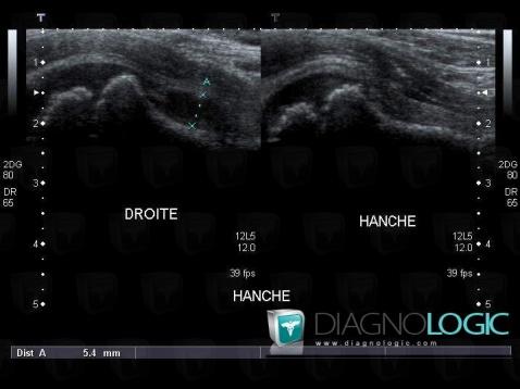 épanchement articulaire, Articulation coxo fémorale, Echographie