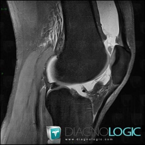 Epanchement intra articulaire, Articulation fémoro patellaire, IRM