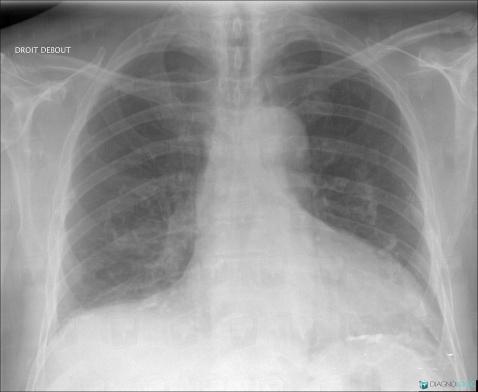 Cas radiologie : Épanchement pleural (Radio) - Diagnologic