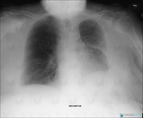 Épanchement pleural, Plèvre, Radio