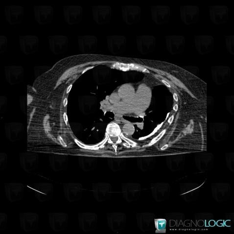 Épanchement pleural, Plèvre, Scanner