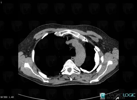 Épanchement pleural, Plèvre, Scanner