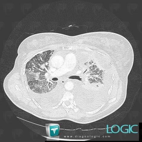 Épanchement pleural, Plèvre, Scanner