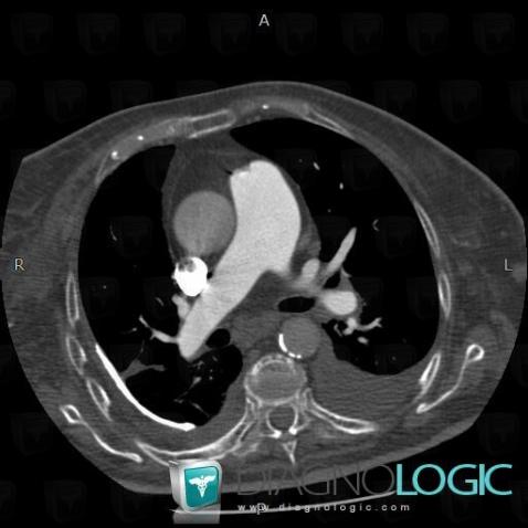 Épanchement pleural, Plèvre, Scanner