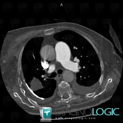 Épanchement pleural, Plèvre, Scanner