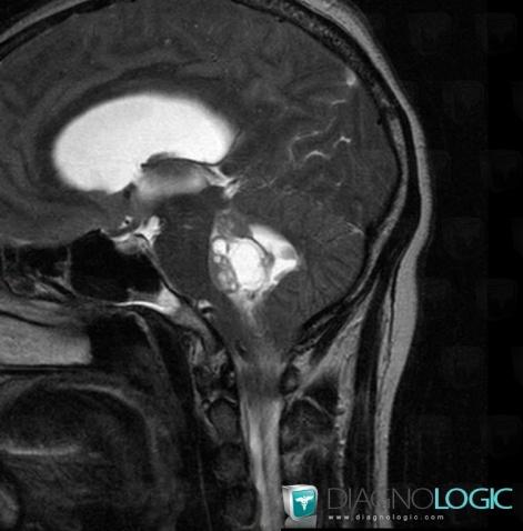 Ependymoma, Posterior fossa, MRI