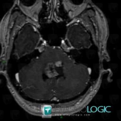 Ependymoma, Posterior fossa, MRI