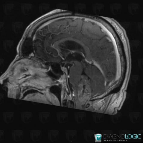 Ependymoma, Posterior fossa, MRI