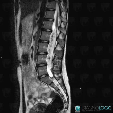 Ependymoma, Spinal canal / Cord, MRI