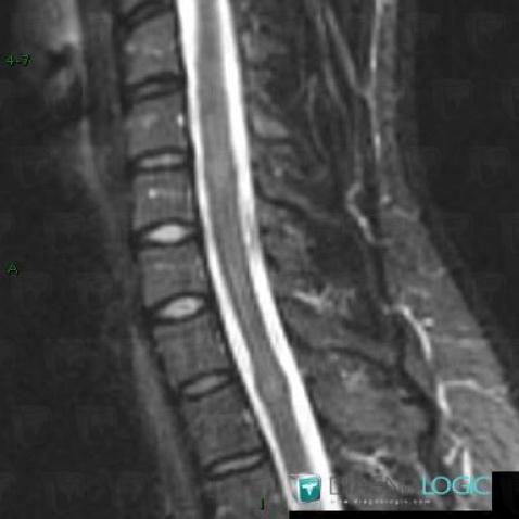 Ependymoma, Spinal canal / Cord, MRI