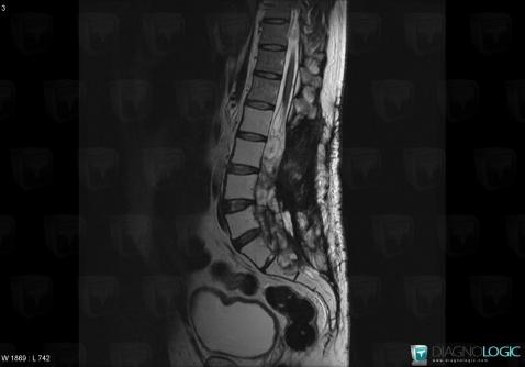 Ependymoma, Spinal canal / Cord, MRI