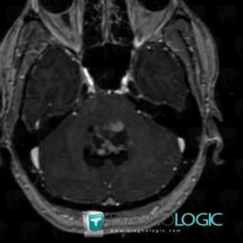 Ependymoma, V4 and vermis, MRI