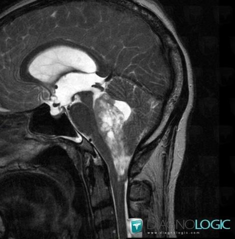 Ependymoma, V4 and vermis, Posterior fossa, MRI