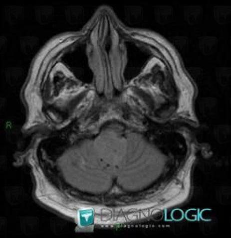 Ependymoma, V4 and vermis, Posterior fossa, MRI