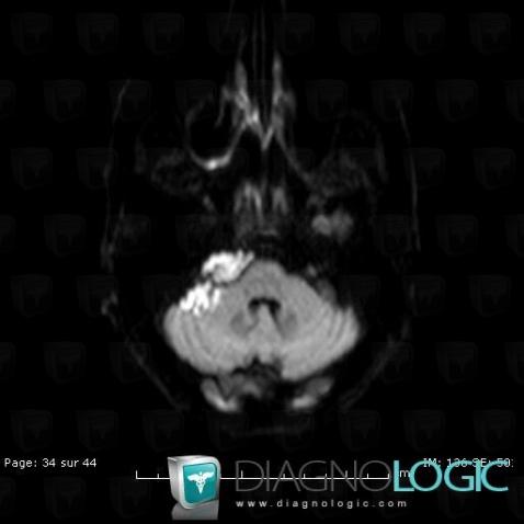 Epidermoid cyst, Cerebellopontine angle, Infratentorial peri cerebral spaces, MRI