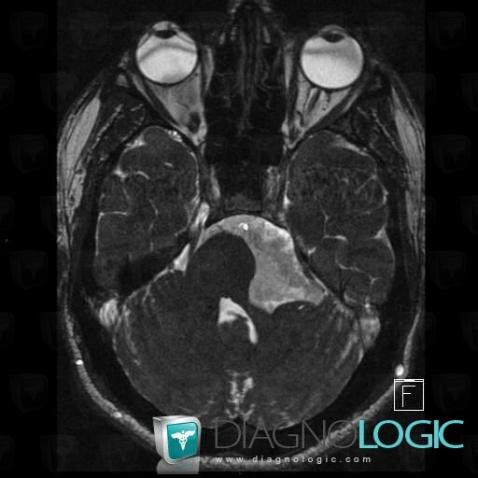 Epidermoid cyst, Cerebellopontine angle, Infratentorial peri cerebral spaces, MRI