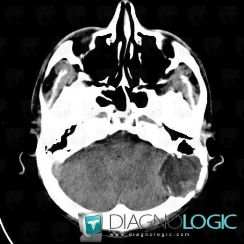 Epidermoid cyst, Cerebral hemispheres, Posterior fossa, CT