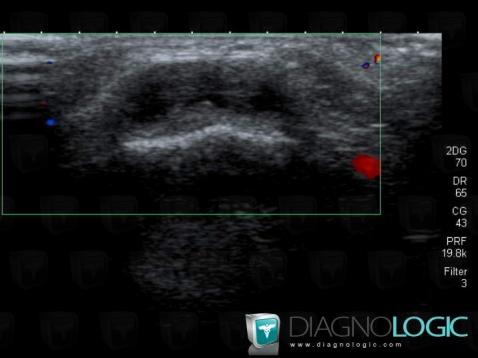 Epidermoid cyst, Eye, US