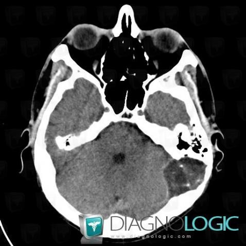 Epidermoid cyst, Infratentorial peri cerebral spaces, Posterior fossa, CT