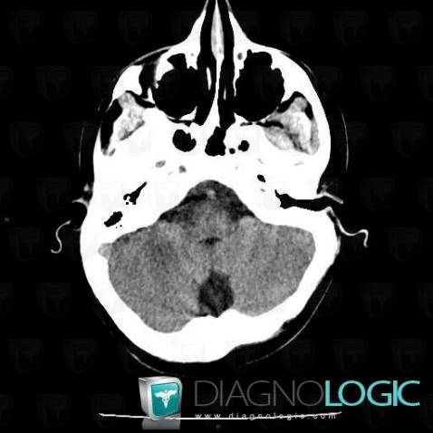 Epidermoid cyst, Infratentorial peri cerebral spaces, Posterior fossa, CT