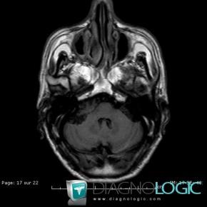 Epidermoid cyst, Posterior fossa, MRI