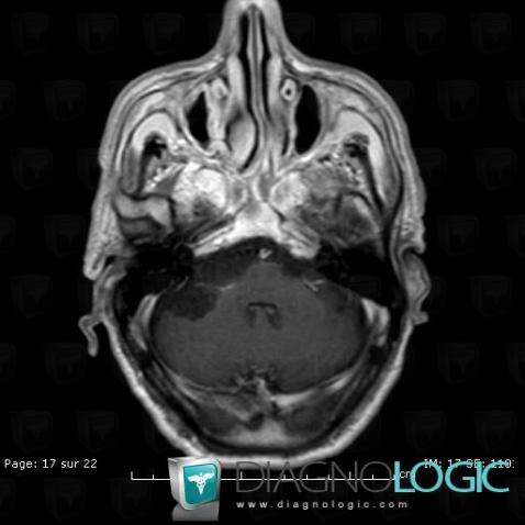 Epidermoid cyst, Posterior fossa, MRI