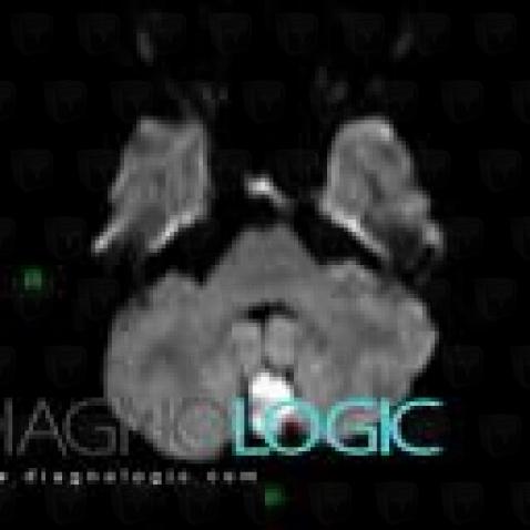 Radiology case : Epidermoid cyst (CT ,MRI) - Diagnologic