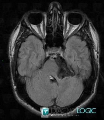 Epidermoid cyst, Posterior fossa, MRI