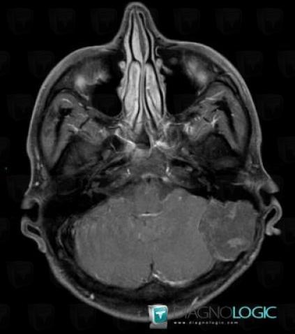 Epidermoid cyst, Posterior fossa, MRI