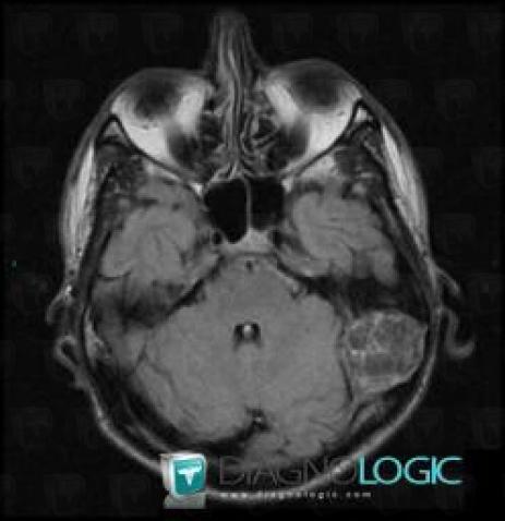 Epidermoid cyst, Posterior fossa, MRI