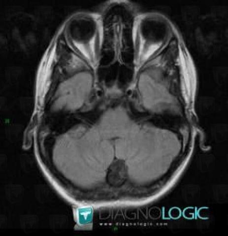 Epidermoid cyst, Posterior fossa, MRI