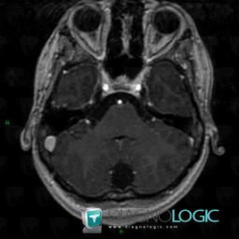 Epidermoid cyst, Posterior fossa, MRI