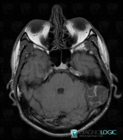 Epidermoid cyst, Posterior fossa, MRI